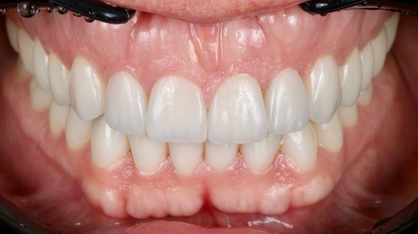 Before