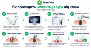 Етапи імплантації зуба під ключ у Києві